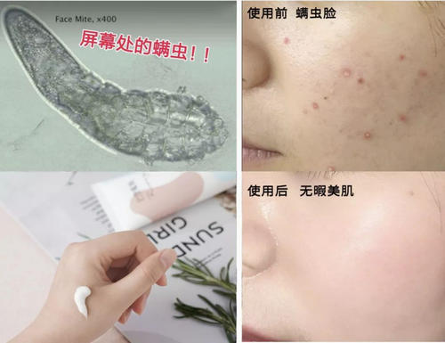 如何治疗螨虫