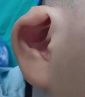 为什么耳朵会红