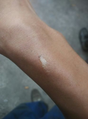 破皮了怎么处理