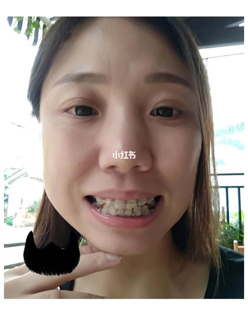 30岁做牙齿矫正